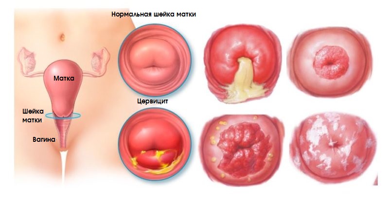 Болячки На Клиторе