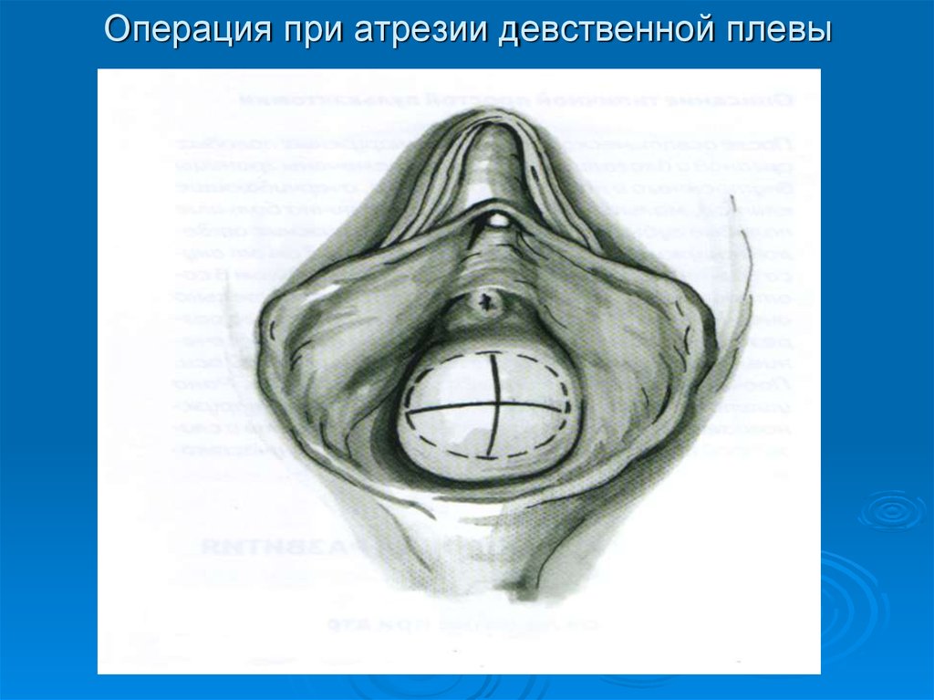 Как Выглядит Девственная Вагина