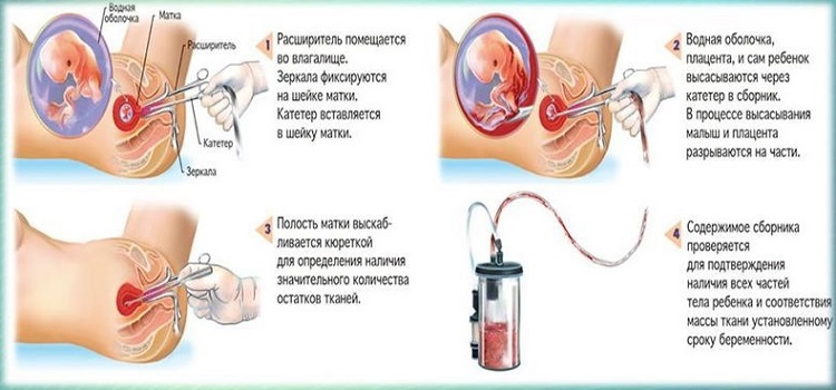 Анальный Секс После Аборта