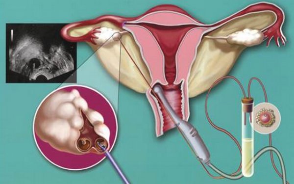 Влагалищная Инсеминация Спермы