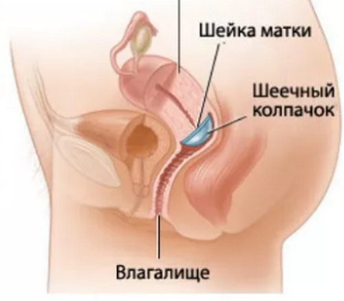 Внутривагинальный Колпачек