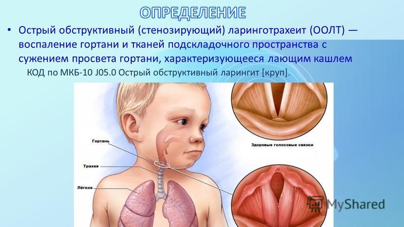 Острый Стенозирующий Ларинготрахеит