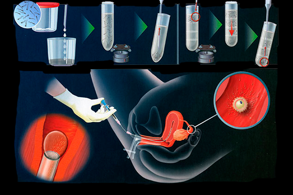Влагалищная Инсеминация Спермы