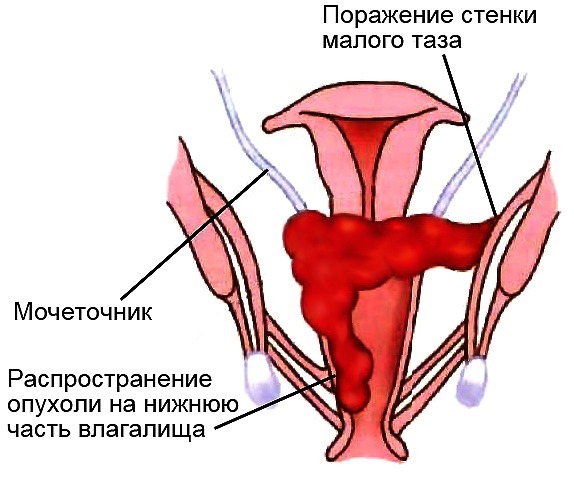 Набухшее Влагалище