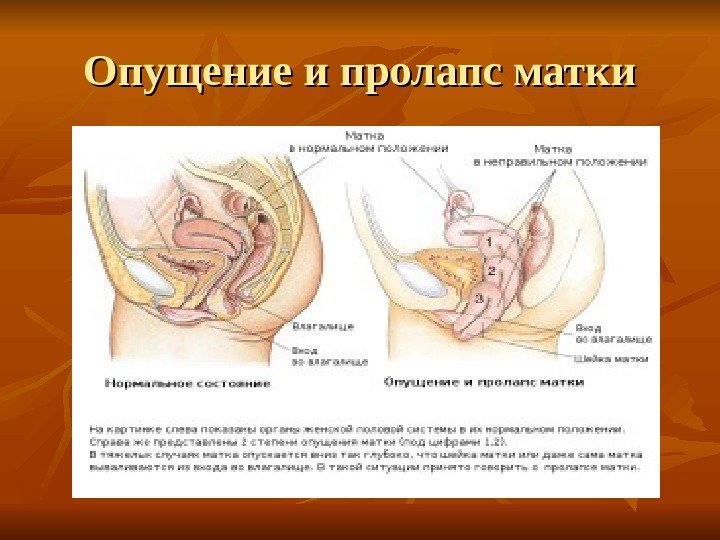 При Натуживании Опускается Влагалище И