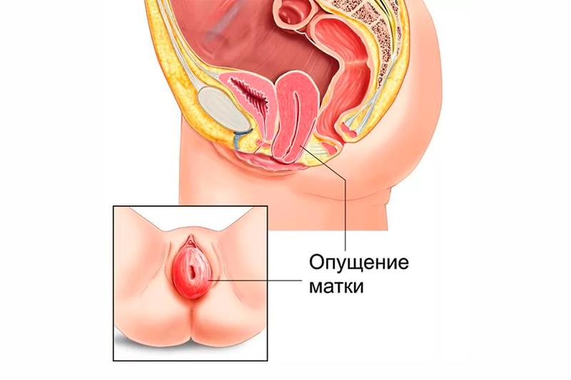 Рези Во Влагалище При Беременности