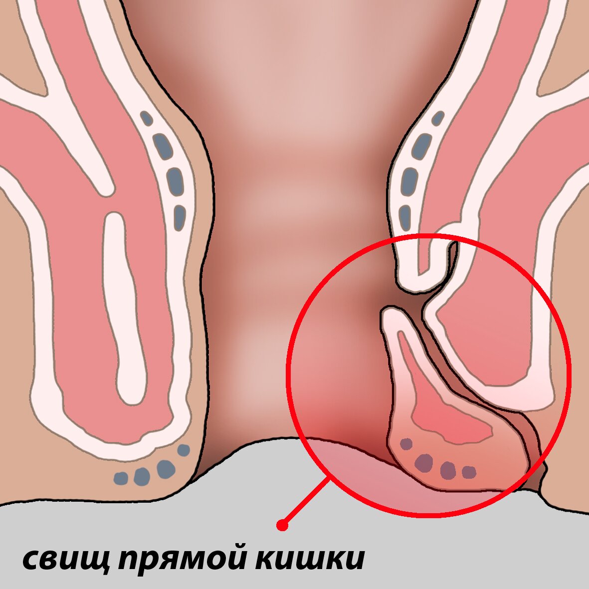 Вылезла Кожица Из Анального Отверстия