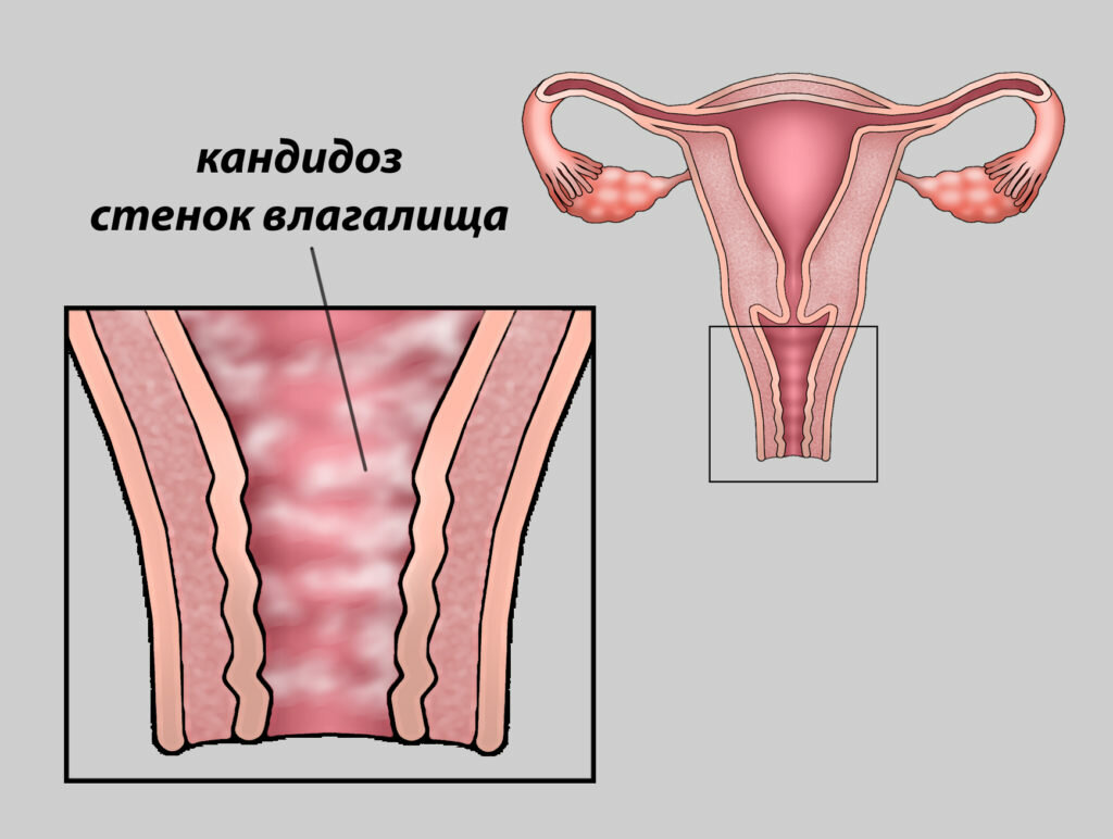Болят Стенки Влагалища
