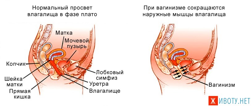 Болят Стенки Влагалища