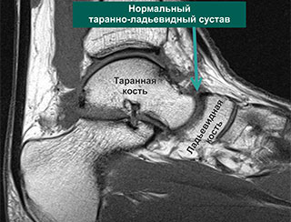 Артроз Таранно Ладьевидных Сочленений