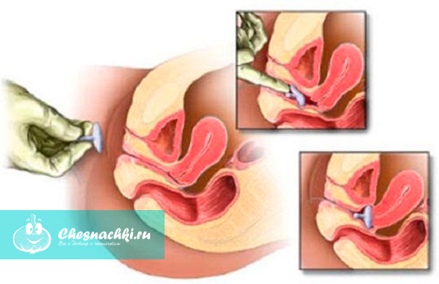 Принатуживании Опускается Влагалище И