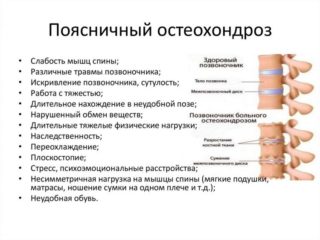 Остеохандроз Крестцовый Отдел Оргазм