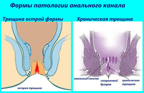 Врожденное Отсутствие Анального Отверстия