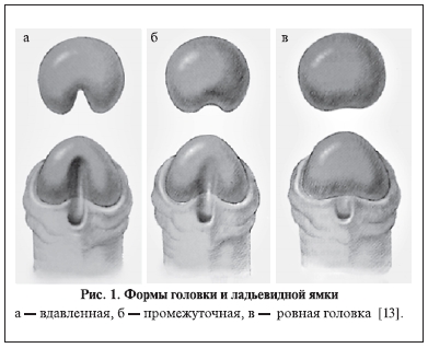 Надрыв Уздечки Члена