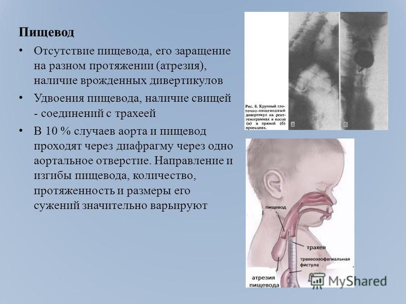 Электрорассечение Врожденный Стеноз Трахеи