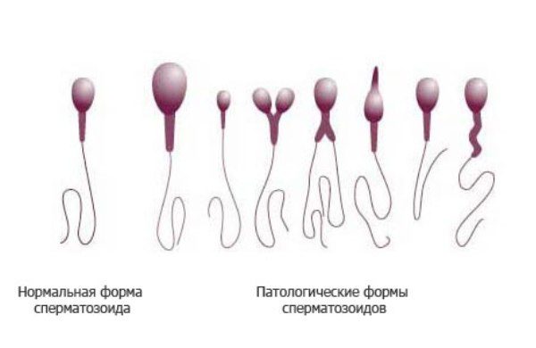 Эко Икси Плохая Морфология Спермы