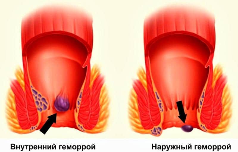 Почесывания В Анальном Отверстии