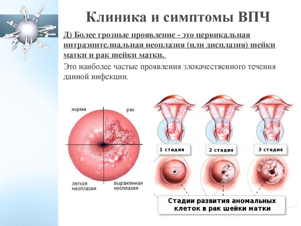 Кондиломы У Входа Во Влагалище