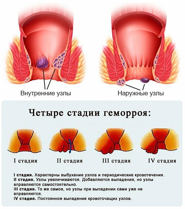 Шишка В Анальном Отверстии