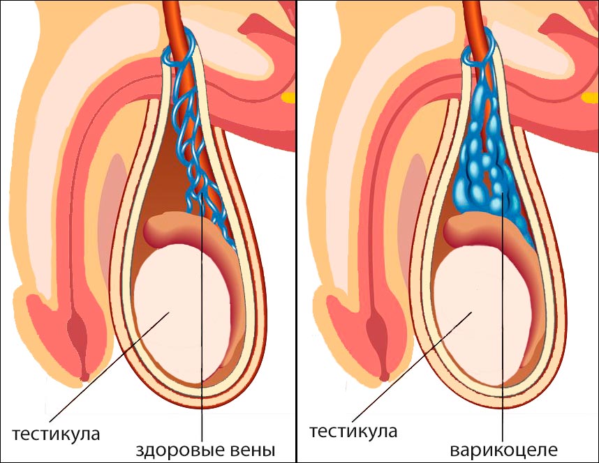 Спайки На Половом Члене