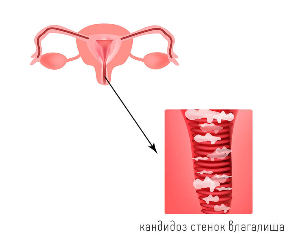 Налет На Стенках Влагалища