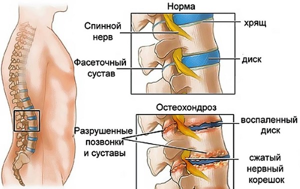 Остеохандроз Крестцовый Отдел Оргазм