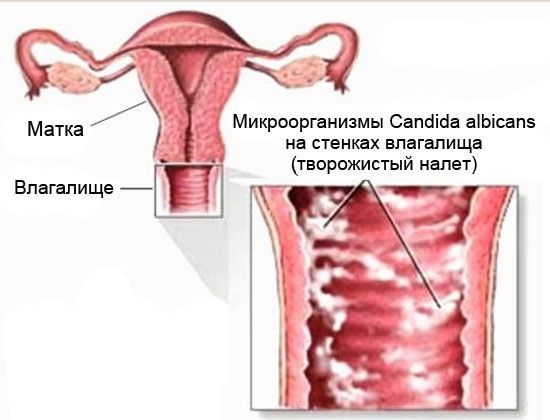 Бывает Молочница У Девственниц