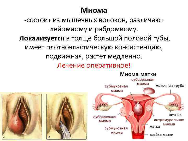 Жжение Преддверия Влагалища