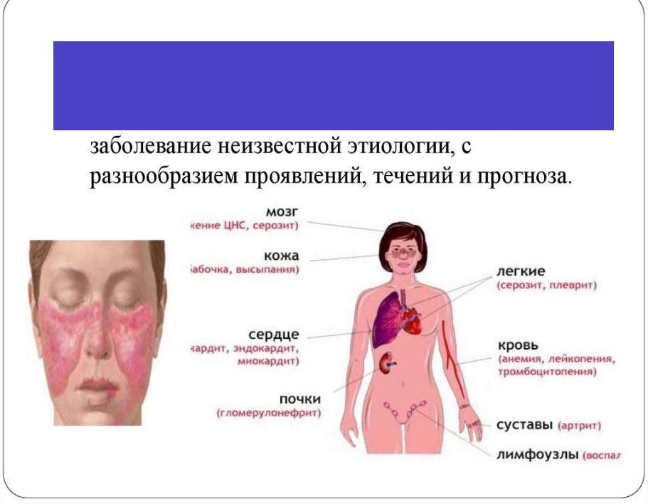 Секс И Системной Красной Волчанке