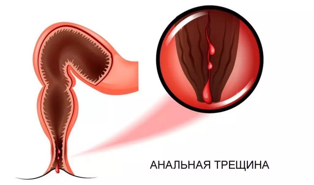 Анальное Кровотечение После Секса