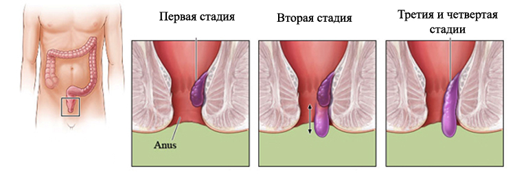 Порванный Анус