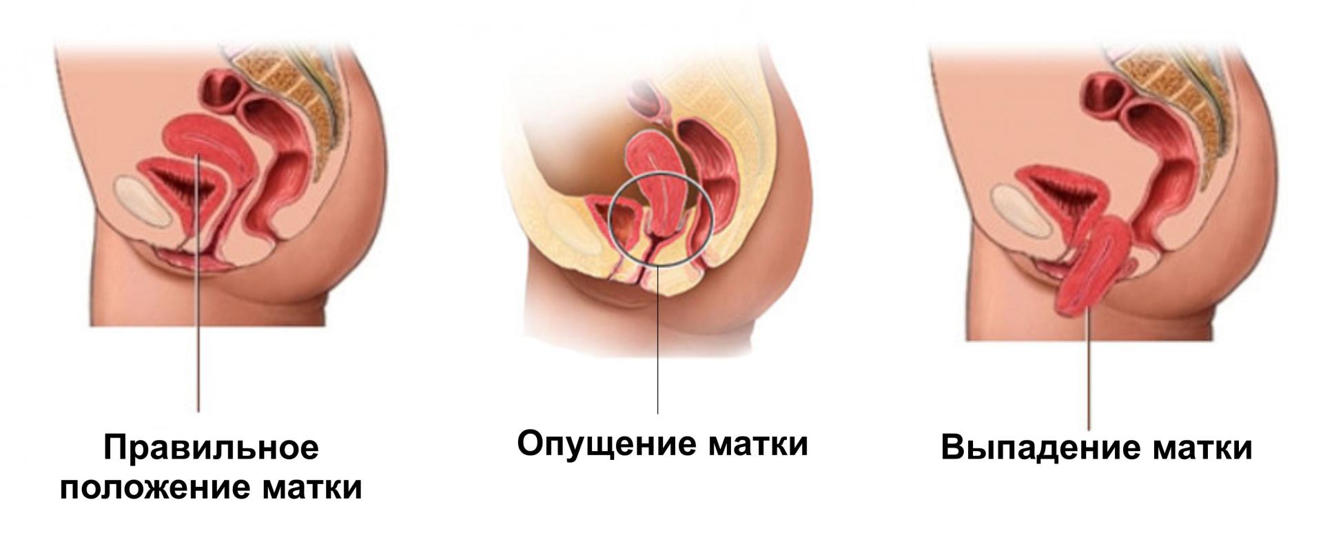 Болят Стенки Влагалища