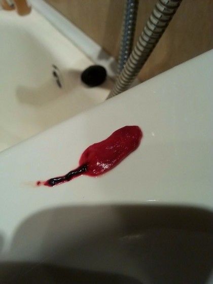 Анальное Кровотечение После Секса