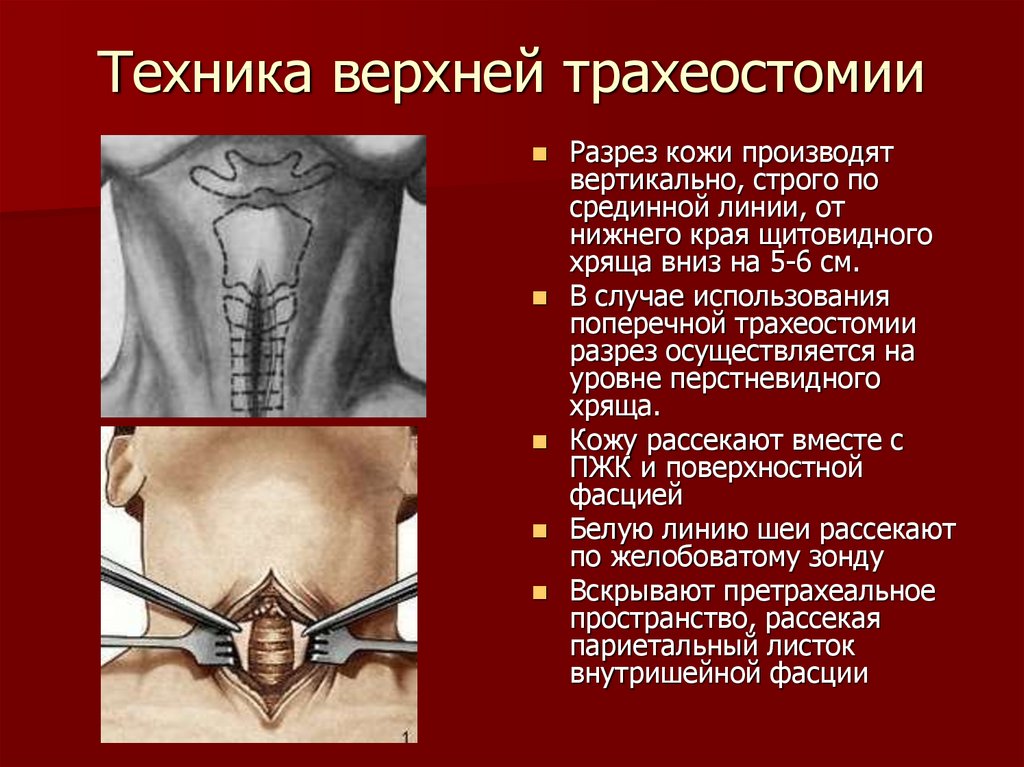 Трахеостомии Трахеотомии Трутнев