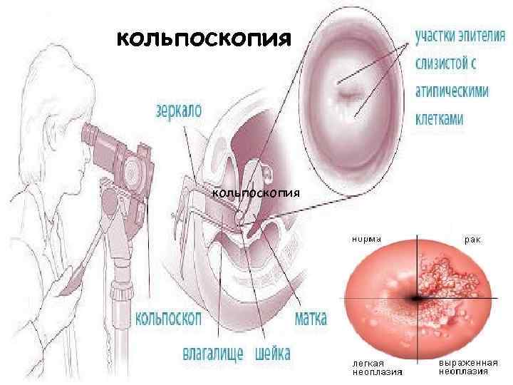 Кальпоскопия Занятие Сексом