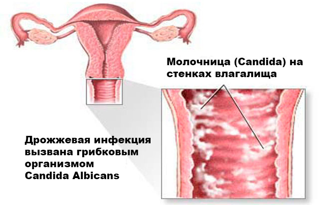 Налет На Стенках Влагалища