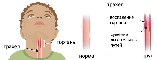 Острый Стенозирующий Ларинготрахеит