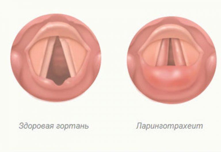 Острый Стенозирующий Ларинготрахеит