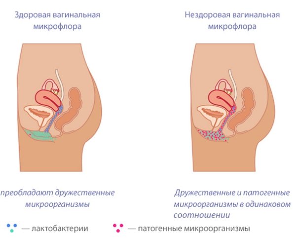 Покалывание Во Влагалище Во Время Беременности