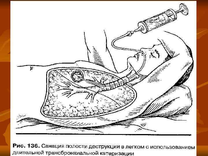 Санация Трахеобронхиального Дерева