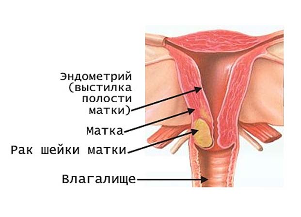 Шарик У Входа Во Влагалище