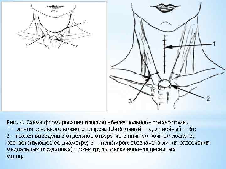 Трахеостома Лоскут Ключица