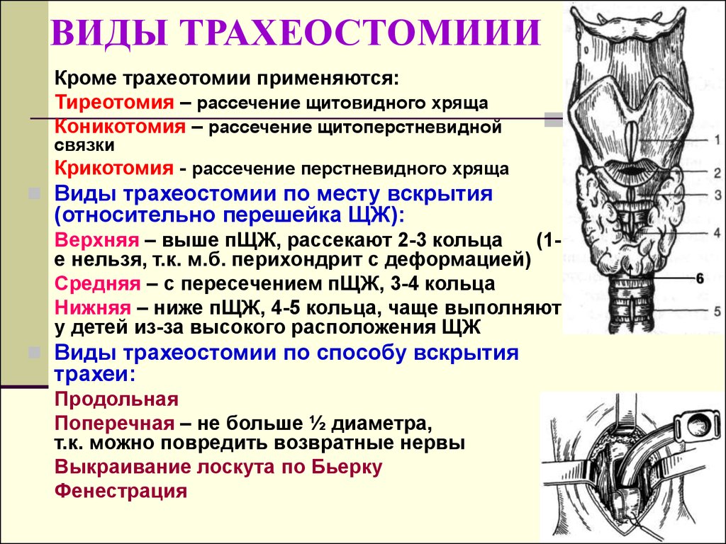 Трахеостомии Трахеотомии Трутнев