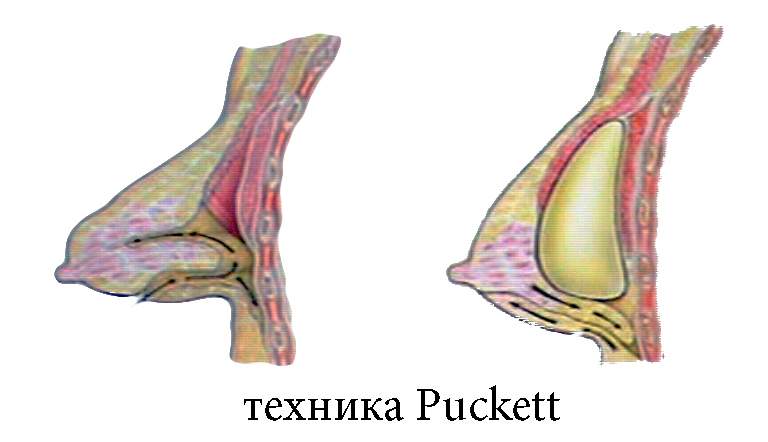 Шишка В Анальном Отверстии