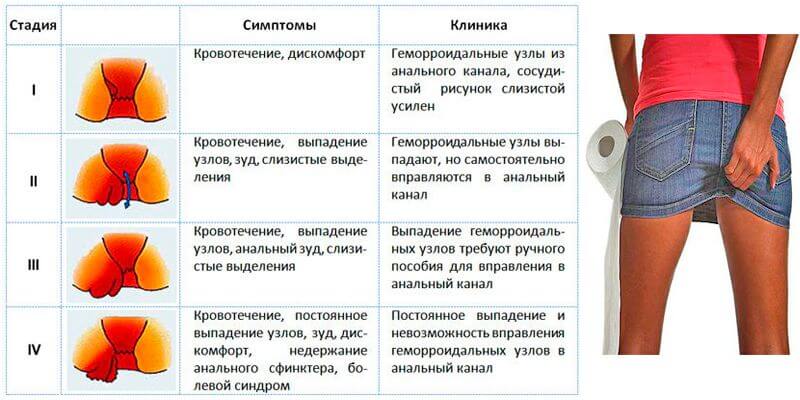 Вылезла Кожица Из Анального Отверстия