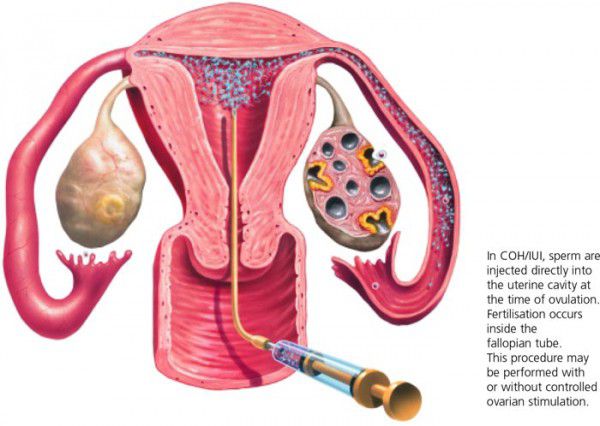 Влагалищная Инсеминация Спермы