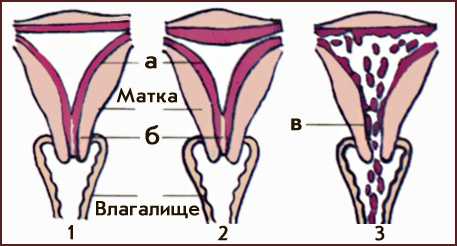 Задержка Менструации Шероховатость Во Влагалище